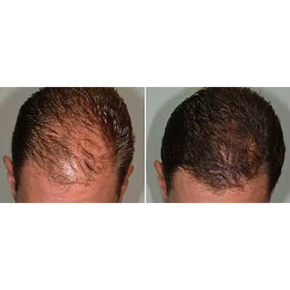 Best Fast Hair Loss Regrowth Shampoo With Organic Oils For Men Women 2
