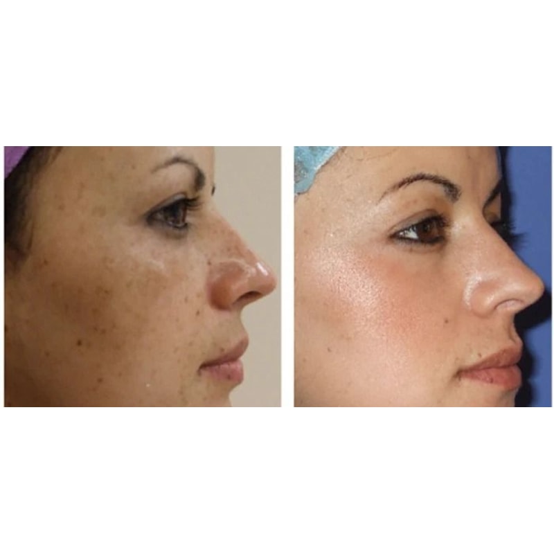 Kojic Acid Brightening Serum 1oz Dark Spot Treatment Uneven Skin Tone Solution 2