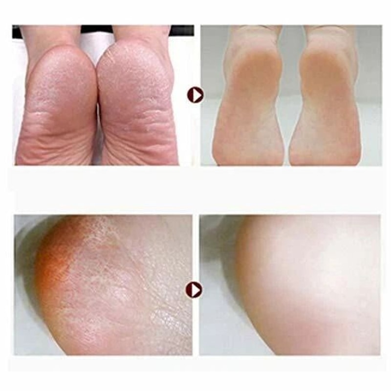 Dual Grit Foot Rasp File Coarse Fine Callus Remover For Smooth Heels Hard Skin 1