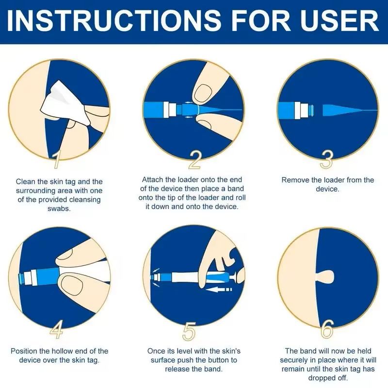 Skin Tag Removal Pen Kit For Painless Tag Removal 4mm To 9mm 1