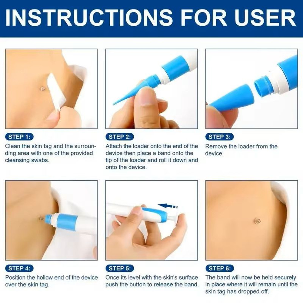 Skin Tag Removal Pen Kit For Painless Tag Removal 4mm To 9mm 2