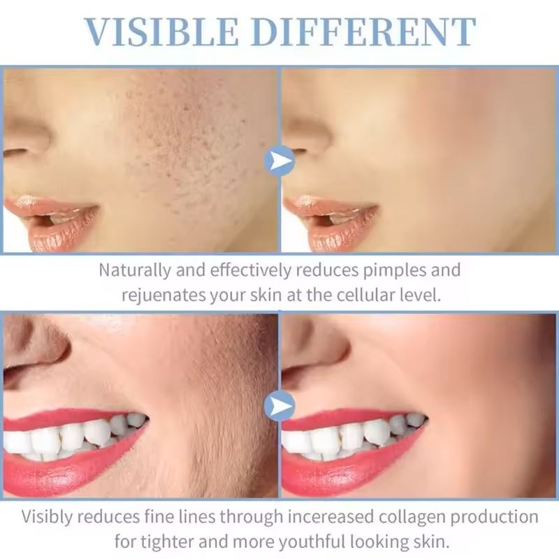 4in1 High Frequency Facial Wand For Acne Treatment And Skin Rejuvenation 5