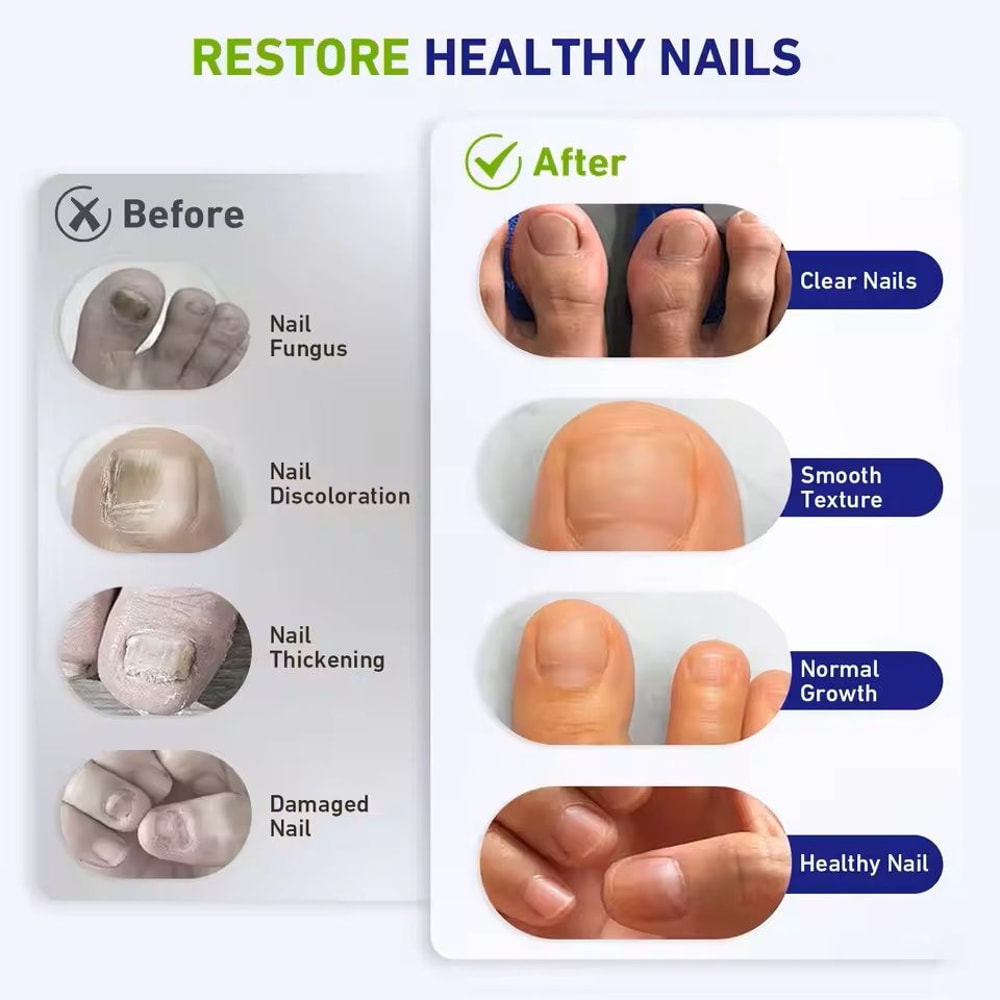 Nail Fungus Laser Device With 57 Beads For Home AntiFungal Treatment 4