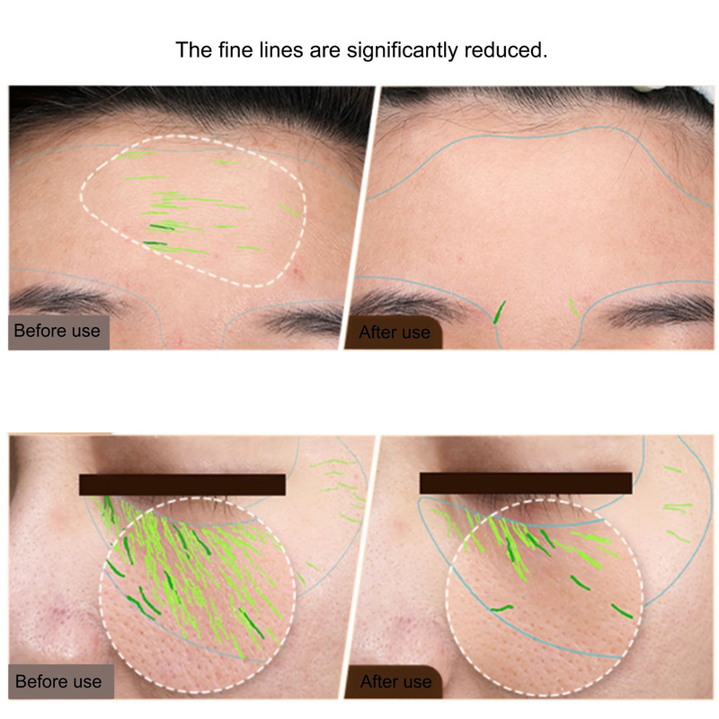 RF EMS Skin Tightening And Lifting Beauty Device For Face And Body 2