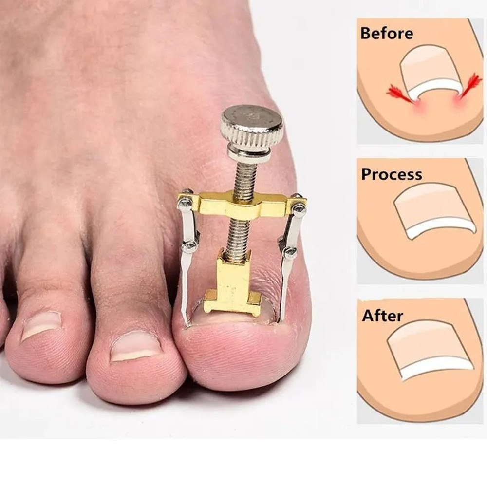 Toenail Correction Bracket Tool For Ingrown Nail Treatment And Paronychia Care 3