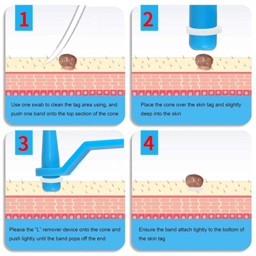 Reusable Skin Tag Rubber Ring Removal Bands Set 5