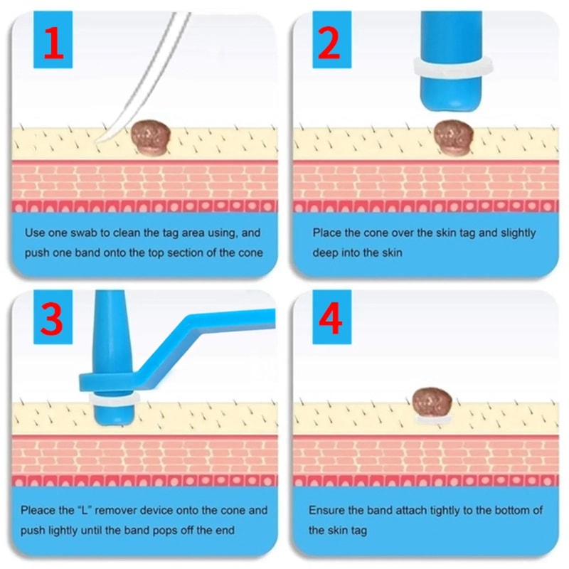 Reusable Skin Tag Rubber Ring Removal Bands Set 5