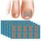 Nail Correction Stickers For Ingrown Toenail Care 0