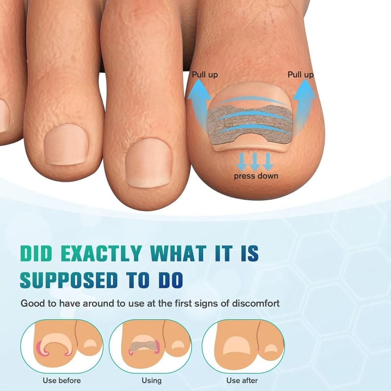 Nail Correction Stickers For Ingrown Toenail Care 3