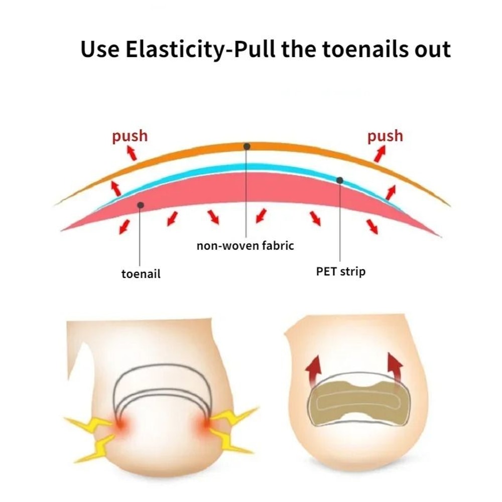 Nail Correction Stickers For Ingrown Toenail Care 4