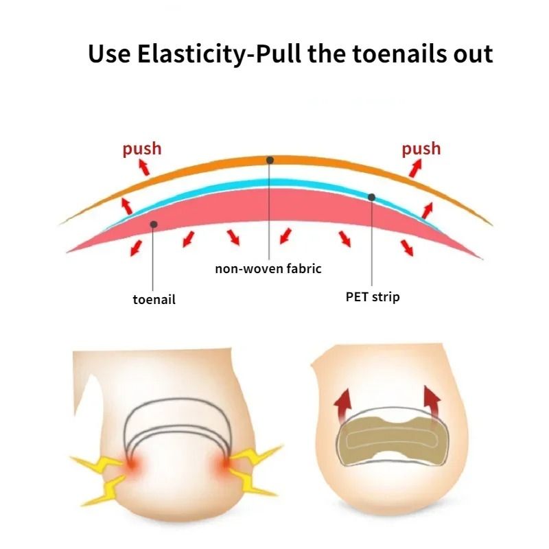 Nail Correction Stickers For Ingrown Toenail Care 4