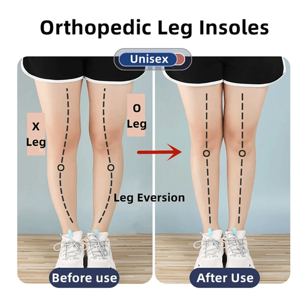 Magnetic Silicone Orthopedic Insoles Plantar Fasciitis Relief Foot Correction Heel Pads For OX Le 4