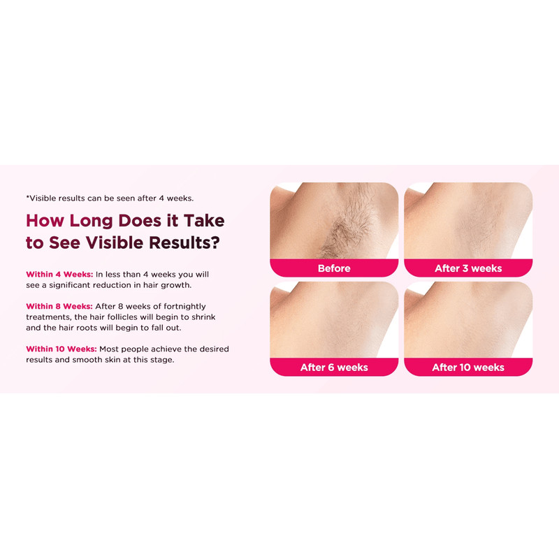 SilkBeam 990000 Flash IPL Hair Removal Device For Face And Body 4