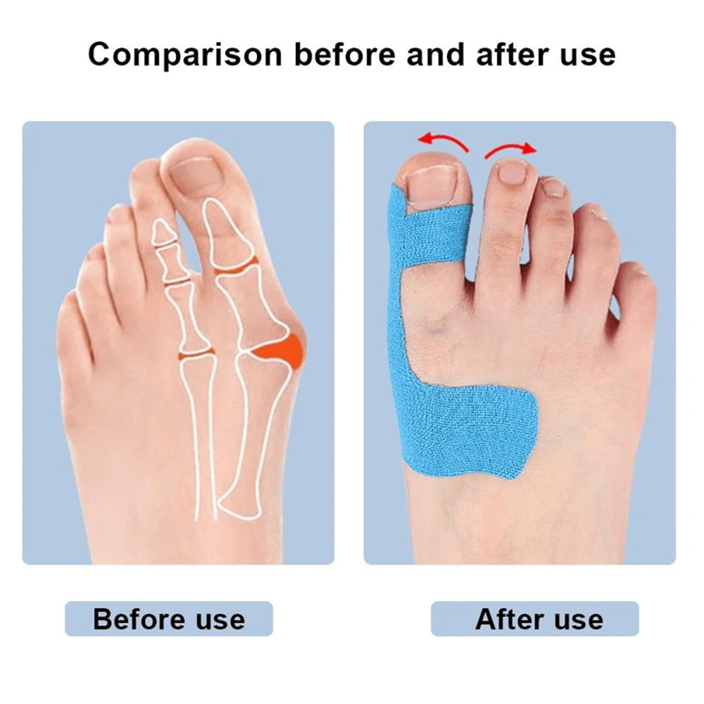 Bunion Corrector Kinesiology Tape For Toe Alignment And Pain Relief 1