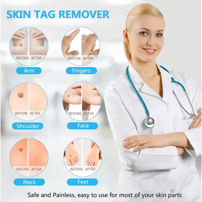 3 In 1 Skin Tag Removal Kit Easy Clean Home Skin Care Tool 1