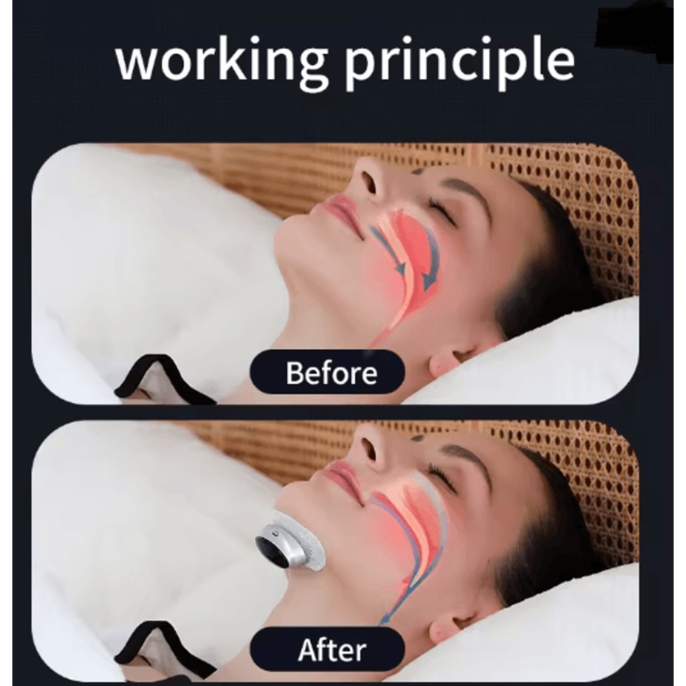 Smart Anti Snoring Device Easy Breathe Sleep Aid With EMS Support 1