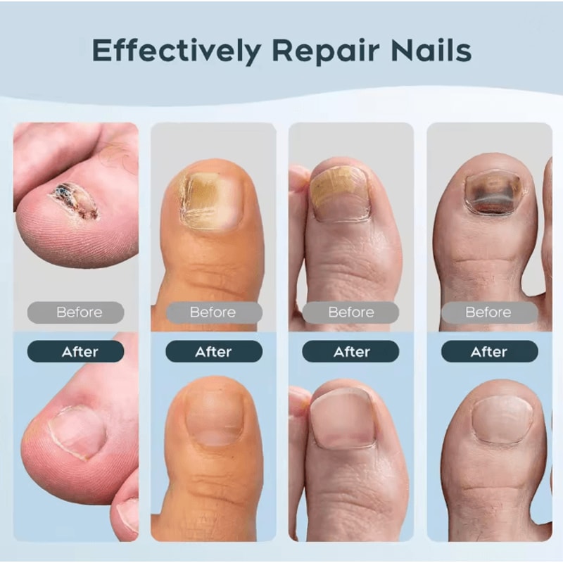 ClearNail Laser Nail Fungus Treatment Device For Toenail Care 3