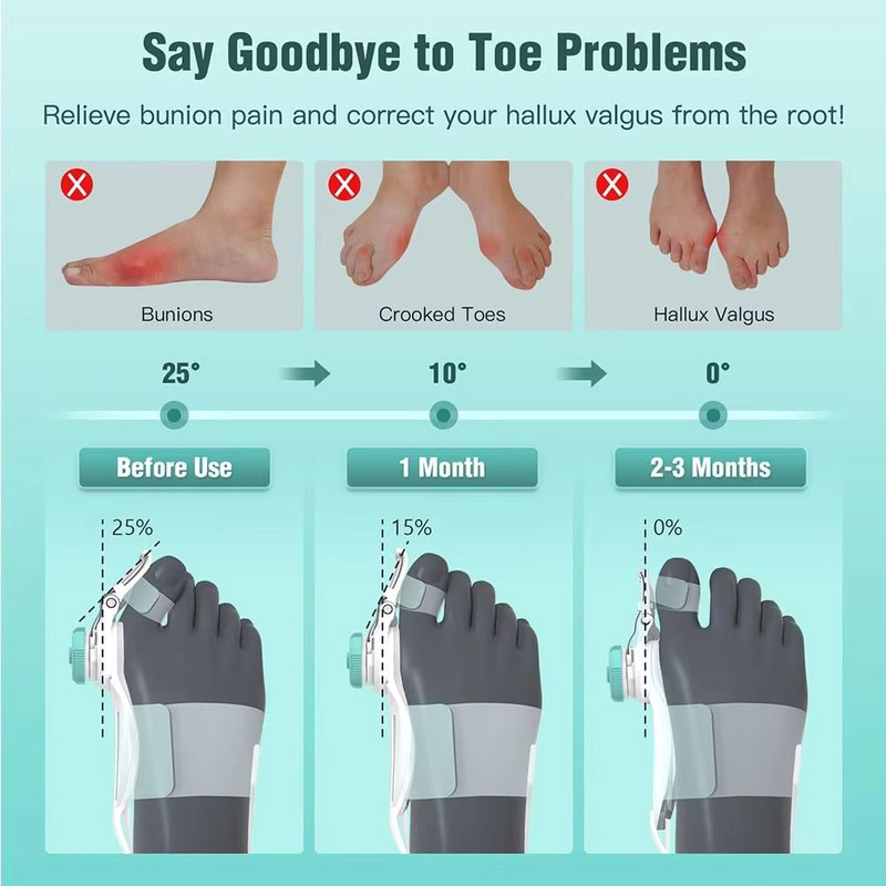 Adjustable Bunion Corrector  Big Toe Straightener And Hallux Valgus Support With Rotating Alignment 2