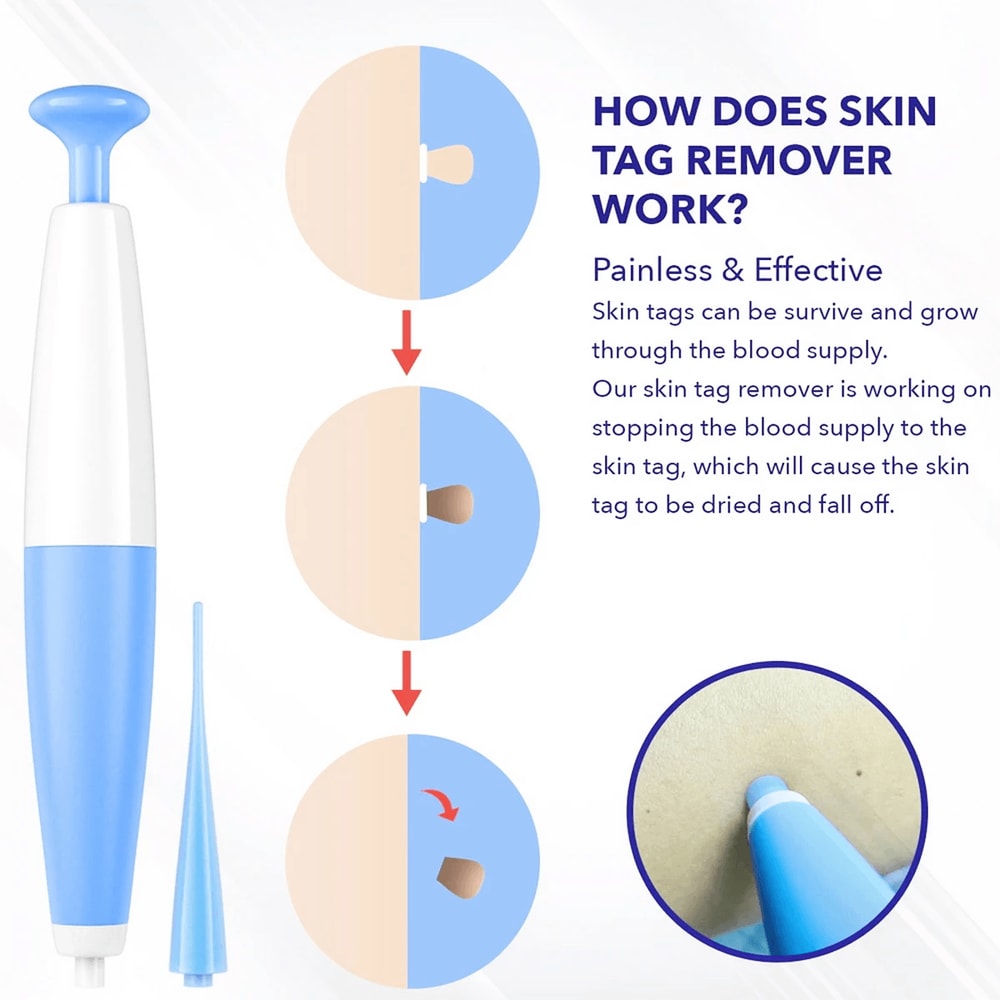Fast and safe skin tag removal device