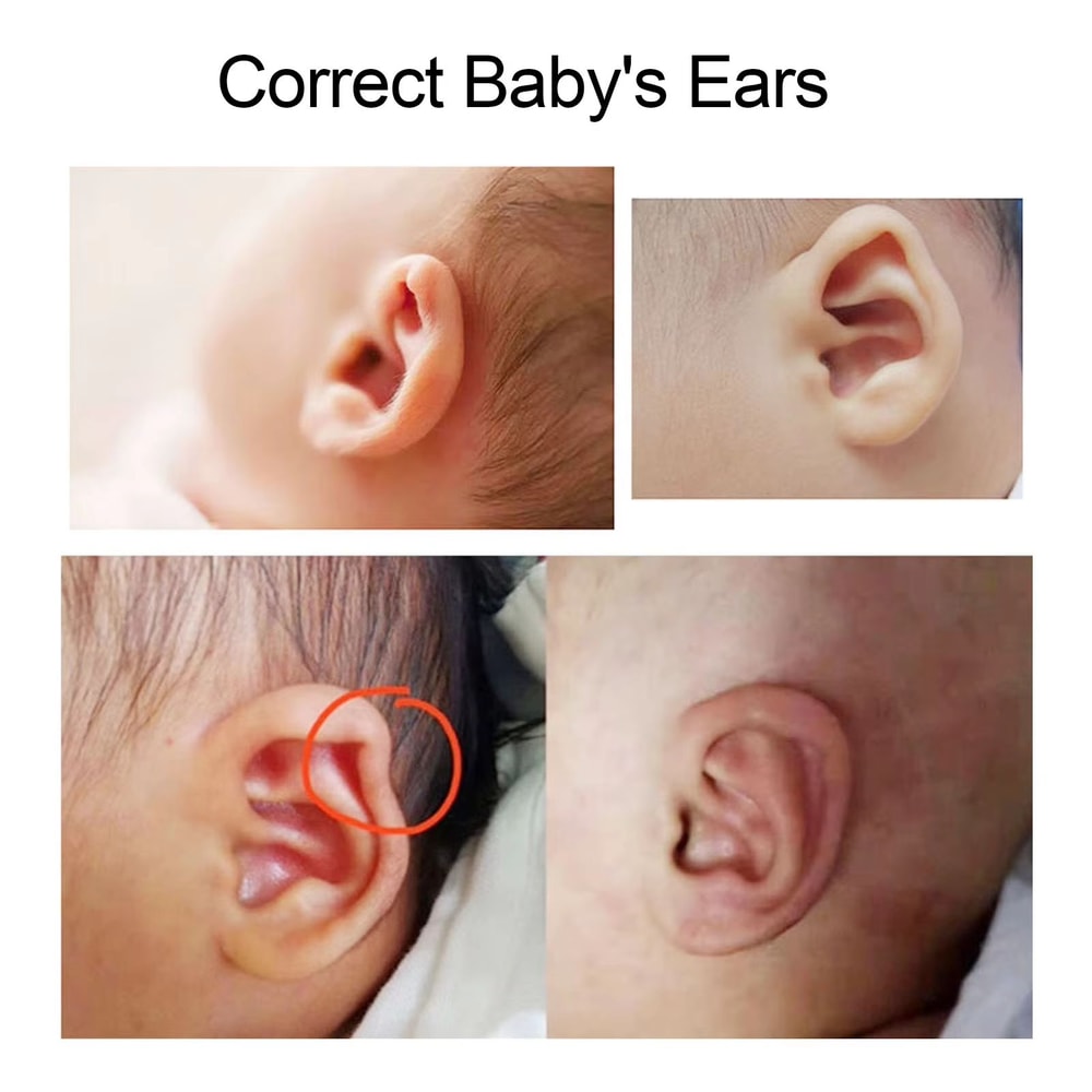 BabyEar Silicone Infant Ear Shape Corrector Patch Strip 4x1969 In Gentle Protruding Ear Alignment 1
