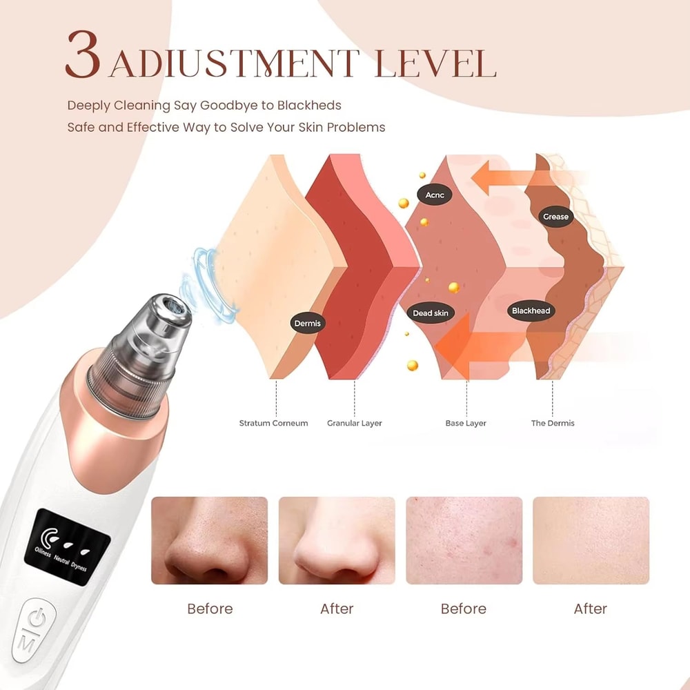 Electric Blackhead Remover Vacuum Pore Cleaner For Acne And Deep Facial Extraction 2