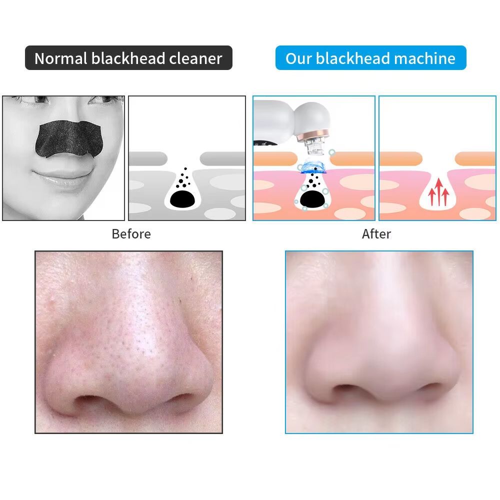 Electric Blackhead Remover Vacuum Suction Pore Cleaner For Face And Nose 5
