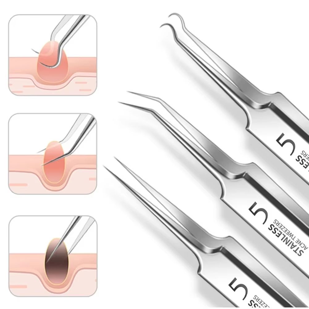 UltraFine No5 Cell Pimples And Blackhead Clip Tweezers Pimple Popper Tool Kit With Acne Needle 2