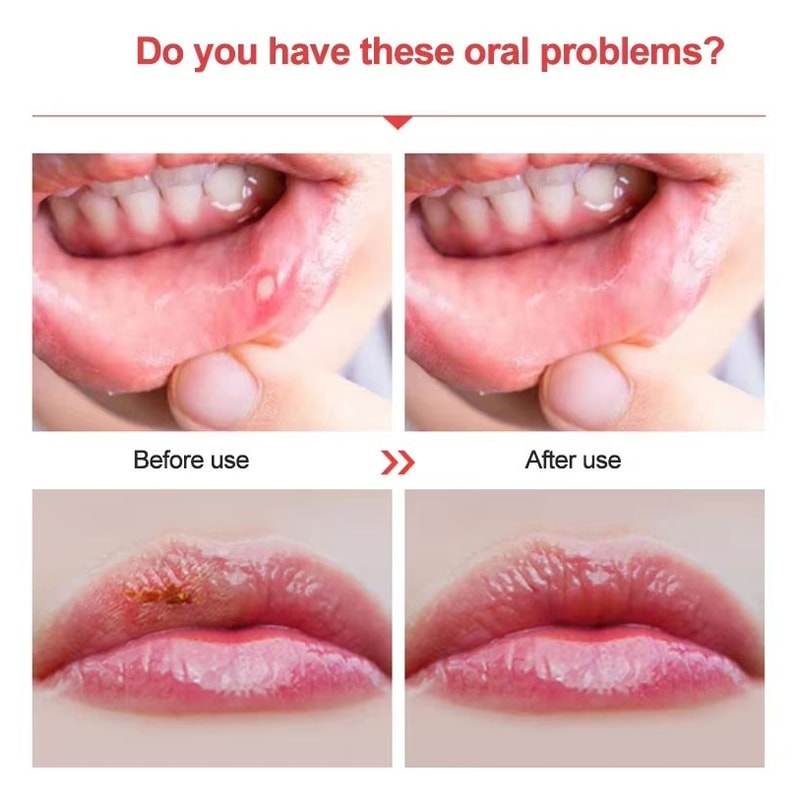 Red Light Therapy Cold Sore Treatment Device With 660 Nm And 850 Nm Near Infrared LED Light Wand 2