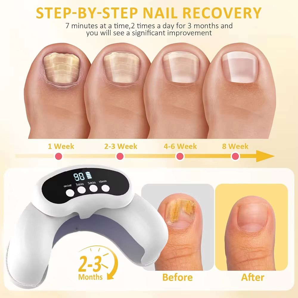 Portable Laser Nail Fungus Treatment Device For Onychomycosis And Ingrown Toenails 3