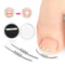 Ingrown Toenail Corrector Clamp Tool For Pain Relief And Nail Straightening Care 0
