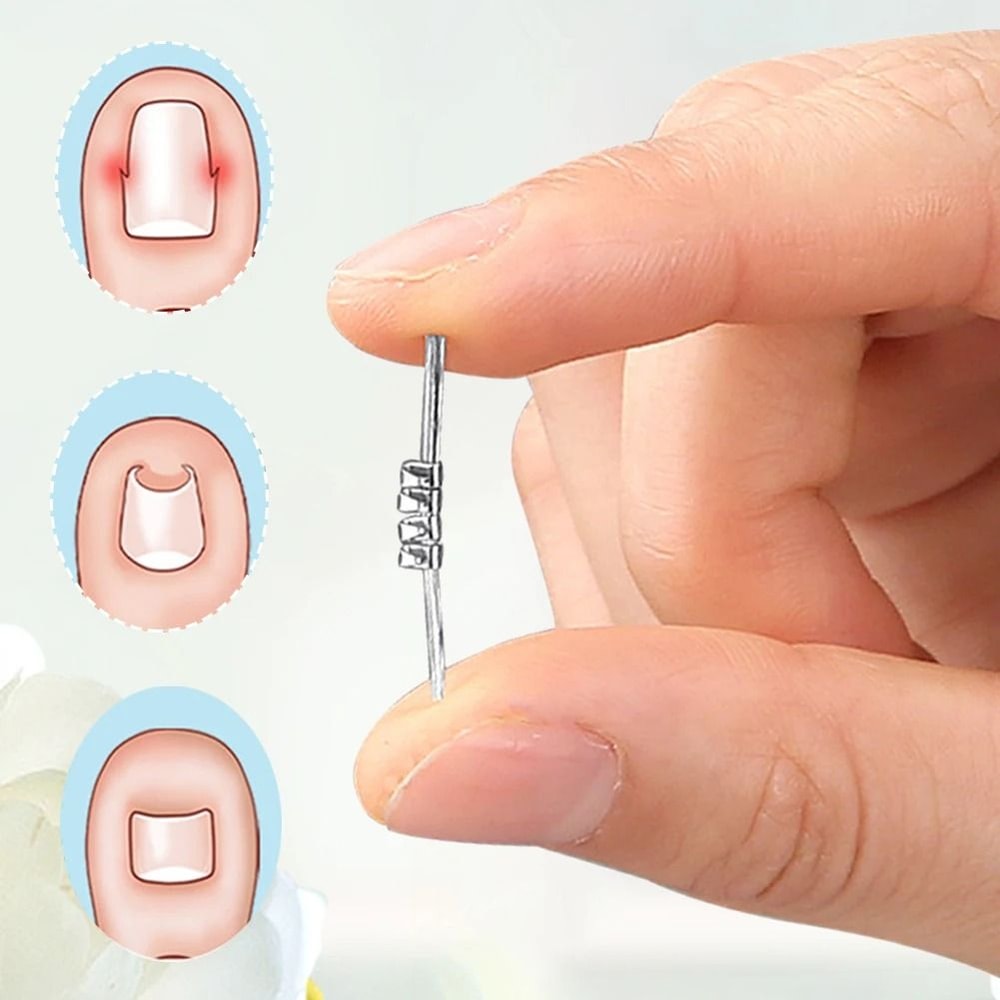 Ingrown Toenail Corrector Clamp Tool For Pain Relief And Nail Straightening Care 4