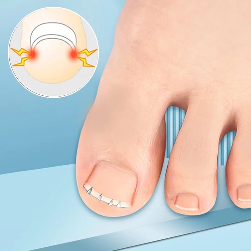 Ingrown Toenail Corrector Clamp Tool For Pain Relief And Nail Straightening Care 5