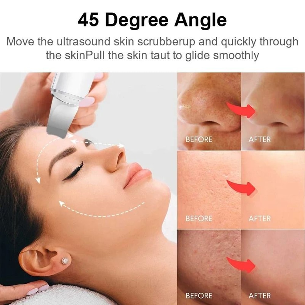 Ultrasonic Skin Scrubber Face Spatula For Deep Cleansing Blackhead Removal 6