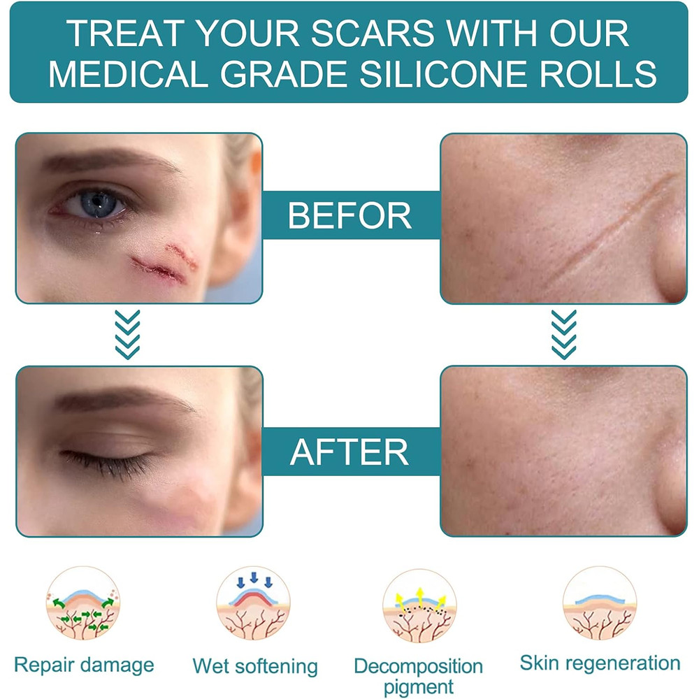 150cm SiliconTreatment E Scar Treatment Tape  Reusable Gel Patch For Acne Burn Surgical  Trauma Sca 5