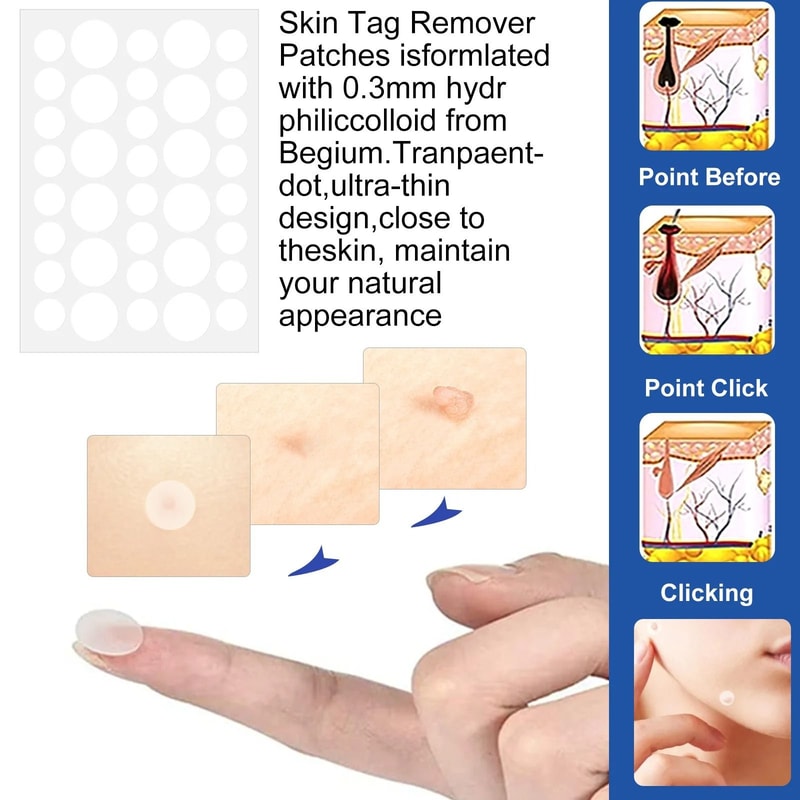 2 In 1 Painless Auto Skin Tag And Mole Remover Kit 2