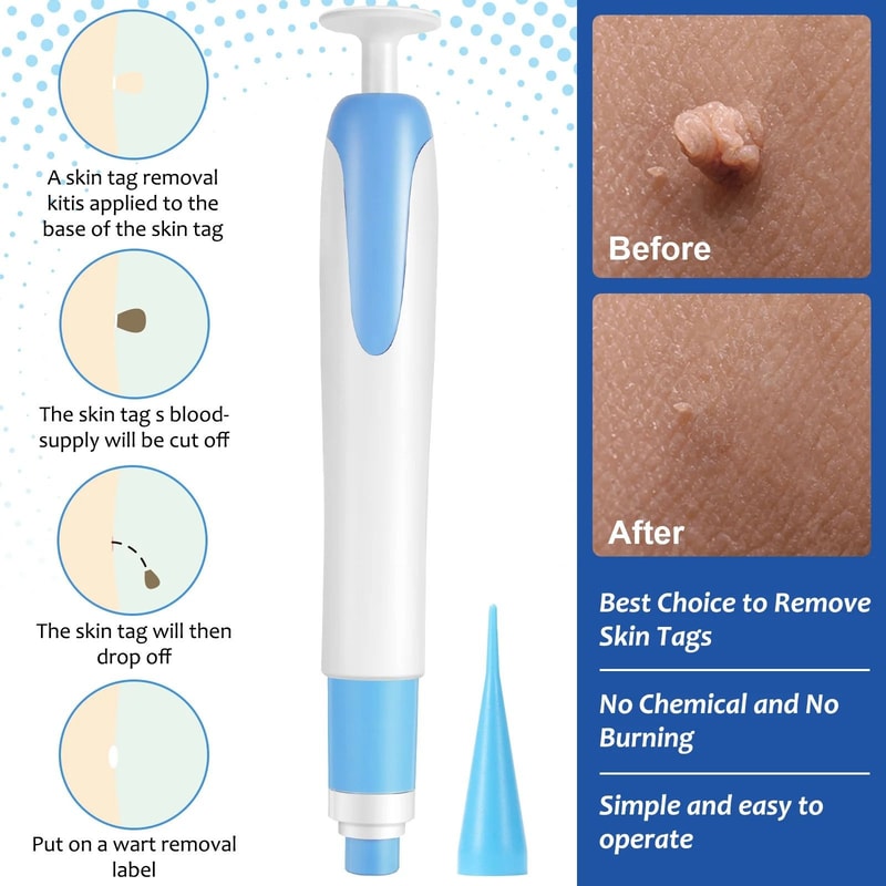 2 In 1 Painless Auto Skin Tag And Mole Remover Kit 5