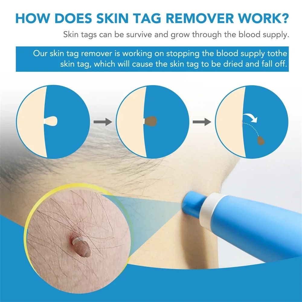 2 IN 1 Auto Micro Skin Tag Remover Device Standard And Micro Removal Kit 1