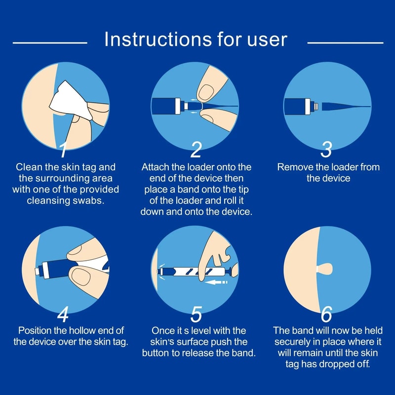 Auto Small Size Skin Tag Removal Kit For Home Facial Skin Care 1 To 4mm Tags 5