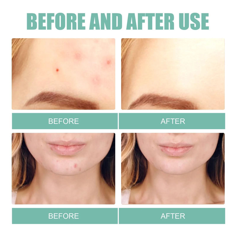 Acne Pimple Patches 132 PCS Hydrocolloid Invisible Skin Care Stickers 1