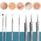 FaciaAcne And Blackhead Remover Tool Set With Ultra Fine Tweezers And Extractor Needles 4