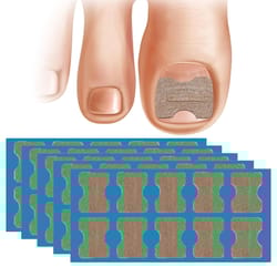 nail correction stickers for ingrown toenail support and pedicure care