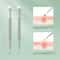 Double Ended Stainless Steel Blackhead And Acne Removal Needle For Facial Cleaning 4