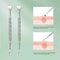 Double Ended Stainless Steel Blackhead And Acne Removal Needle For Facial Cleaning 4
