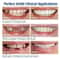 Veneer Snapon Teeth Kit Fake Temporary Tooth Whitening Replacement White Snap Repair Fitting Kit 2