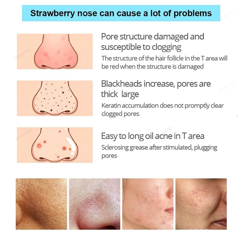 Black Pig Nose Stick Bamboo Charcoal Blackhead Remover Pore Cleaning Acne Treatment Strip 3