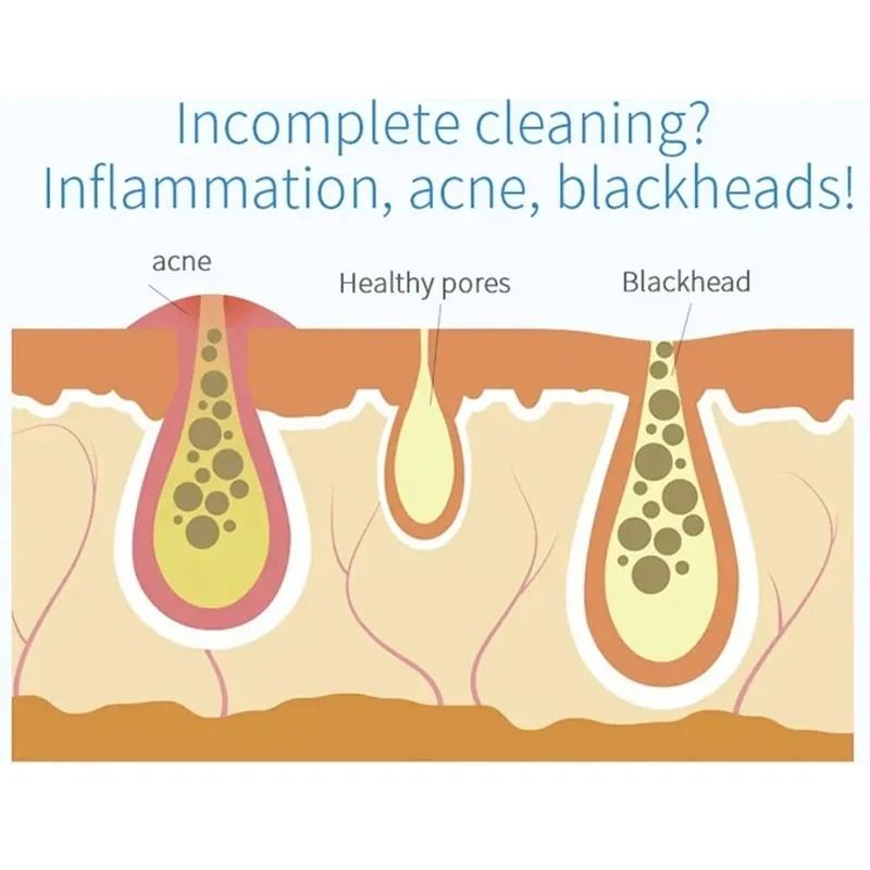 2in1 Bubble Vacuum Blackhead Remover And Pore Cleaner 4