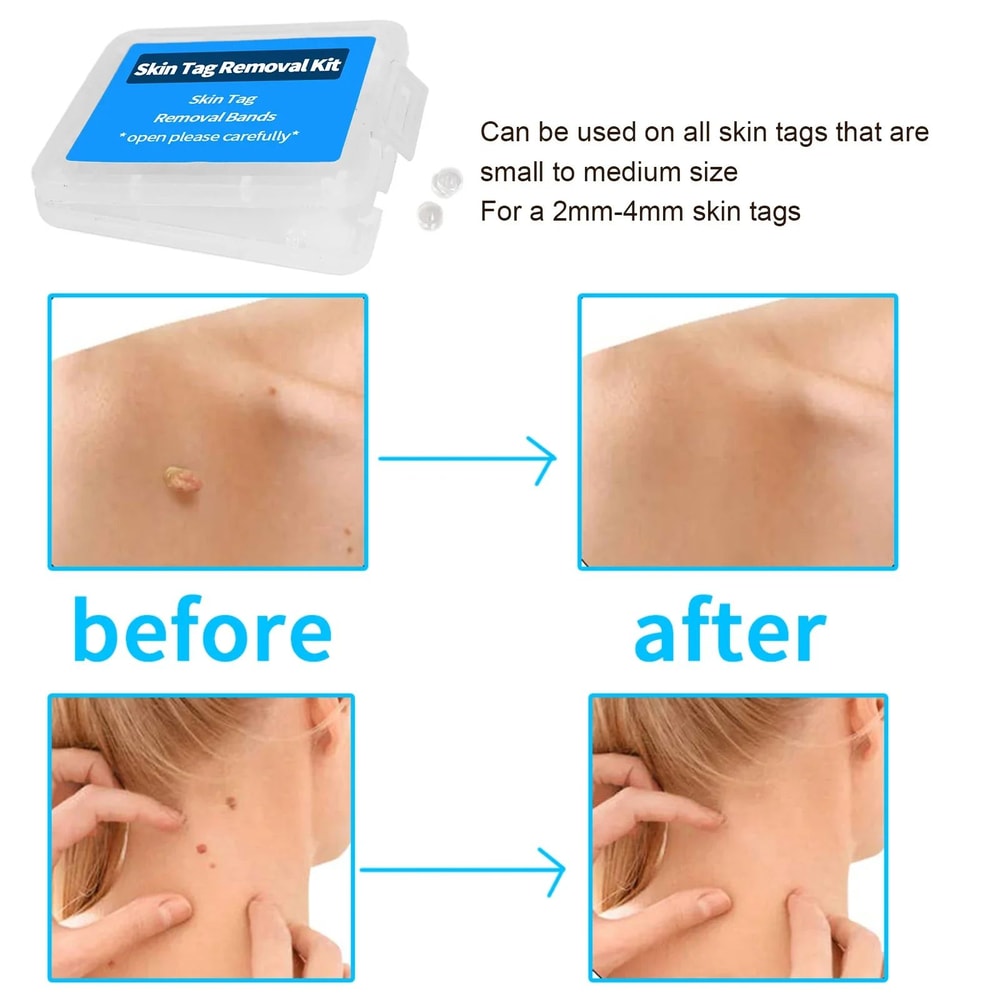 Skin Tag Removal Rubber Ring Set For Safe And Painless Application 4