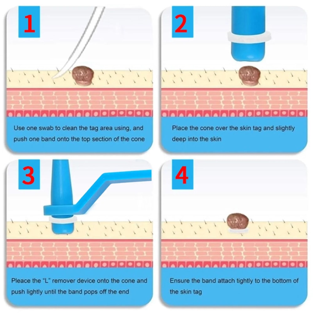 Skin Tag Removal Rubber Ring Set For Safe And Painless Application 5