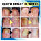 Laser Treatment Pen Set (3).jpg
