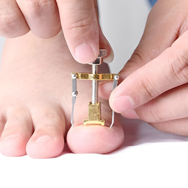 Ingrown Toe Nail Fixer Device (4).jpg